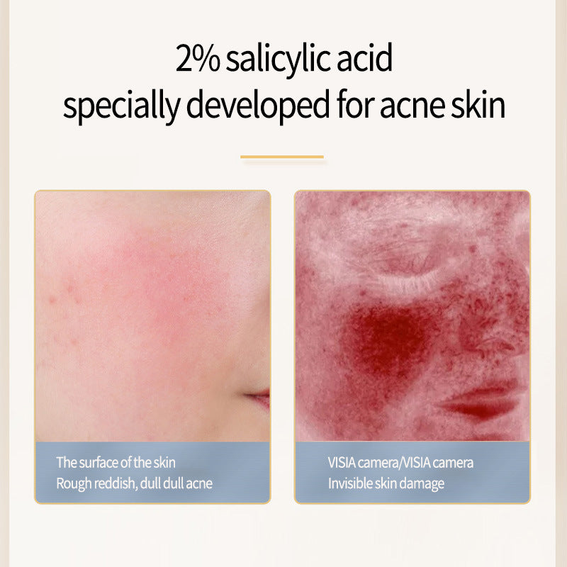 LanSIYI -Salicylic Acid Acne Serum 15ml