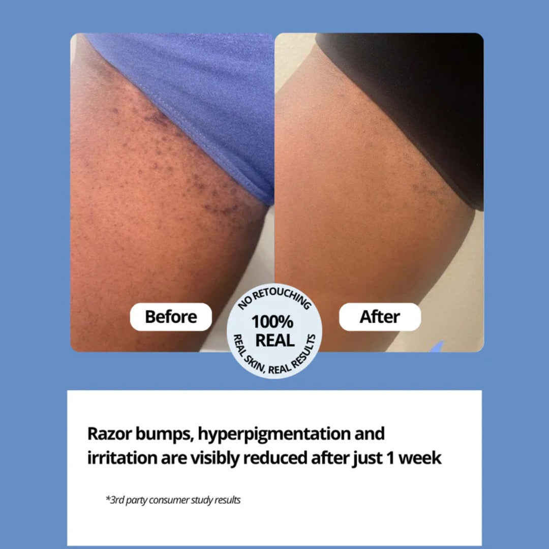 razor bump remover