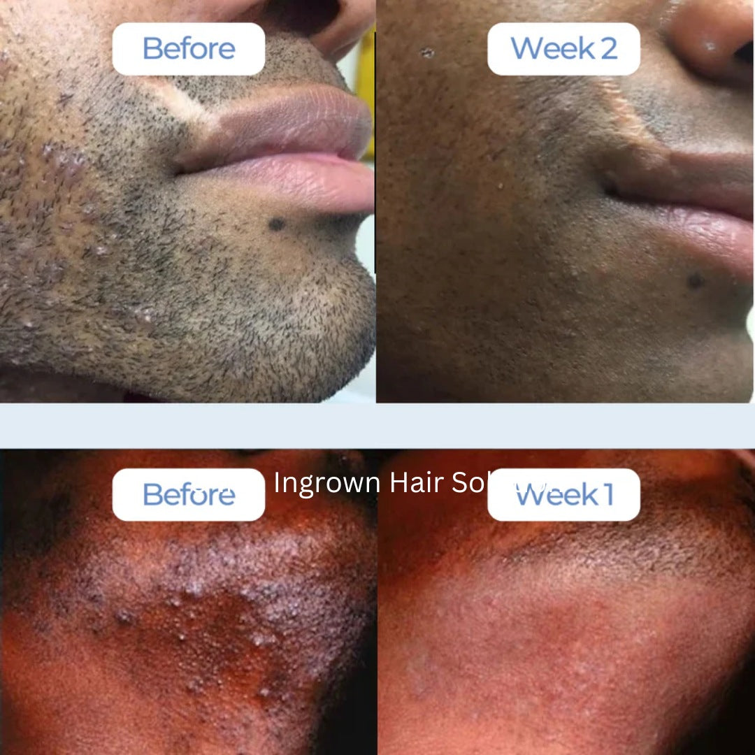 hair removal aftercare