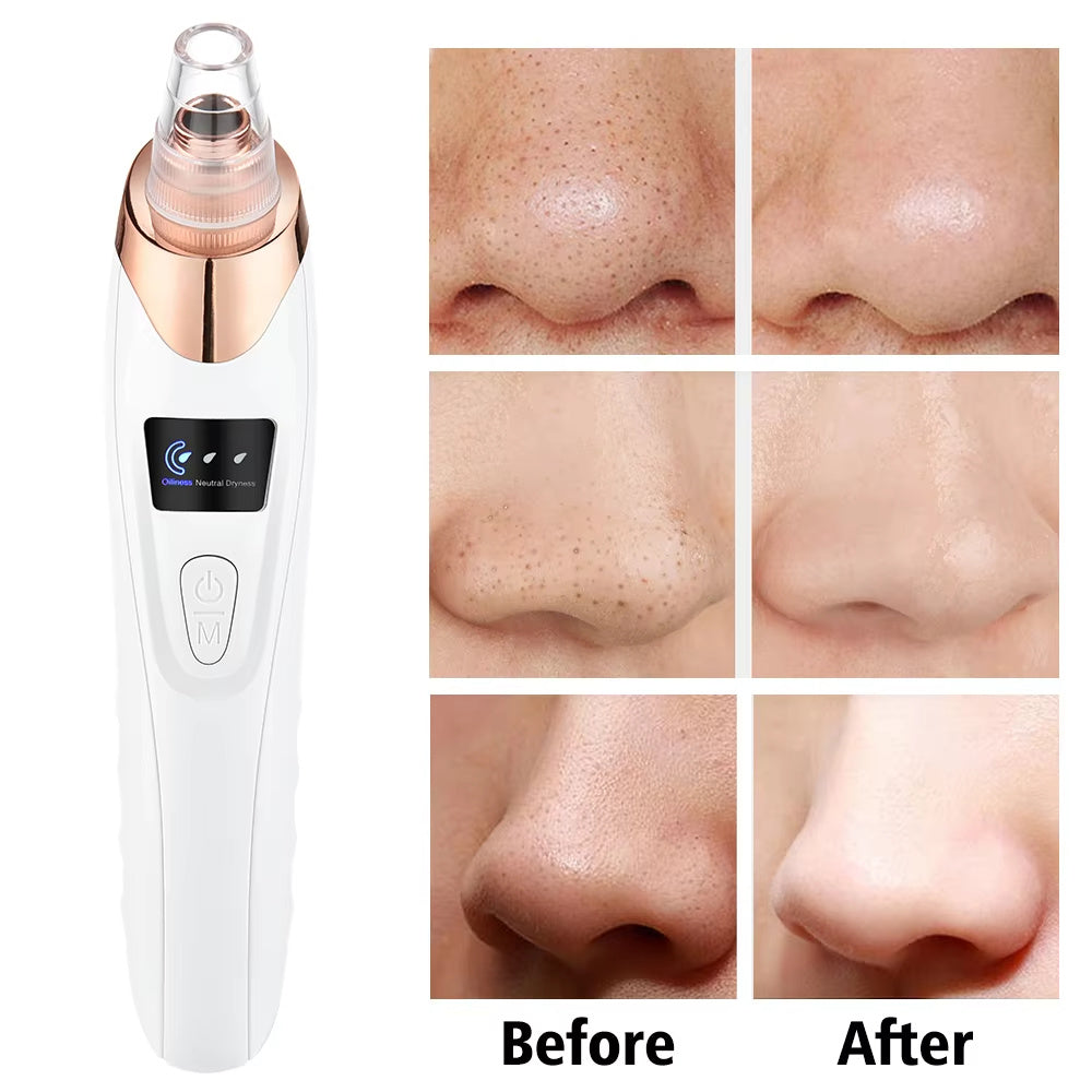 Blackhead Remover