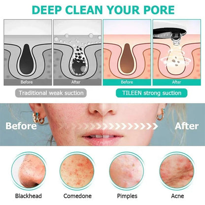 HD blackhead suction